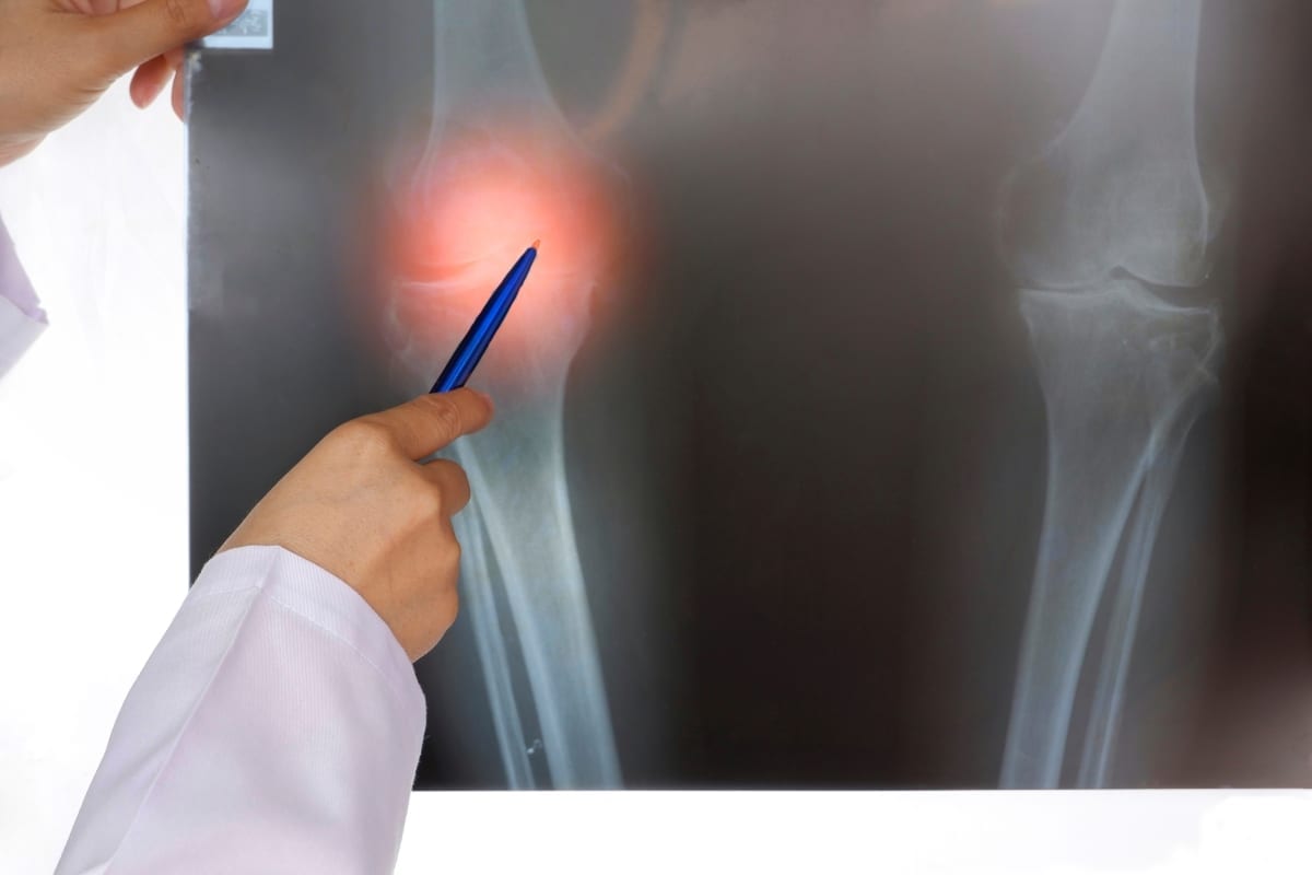 doctor pointing out to an inflamed part of an x-ray