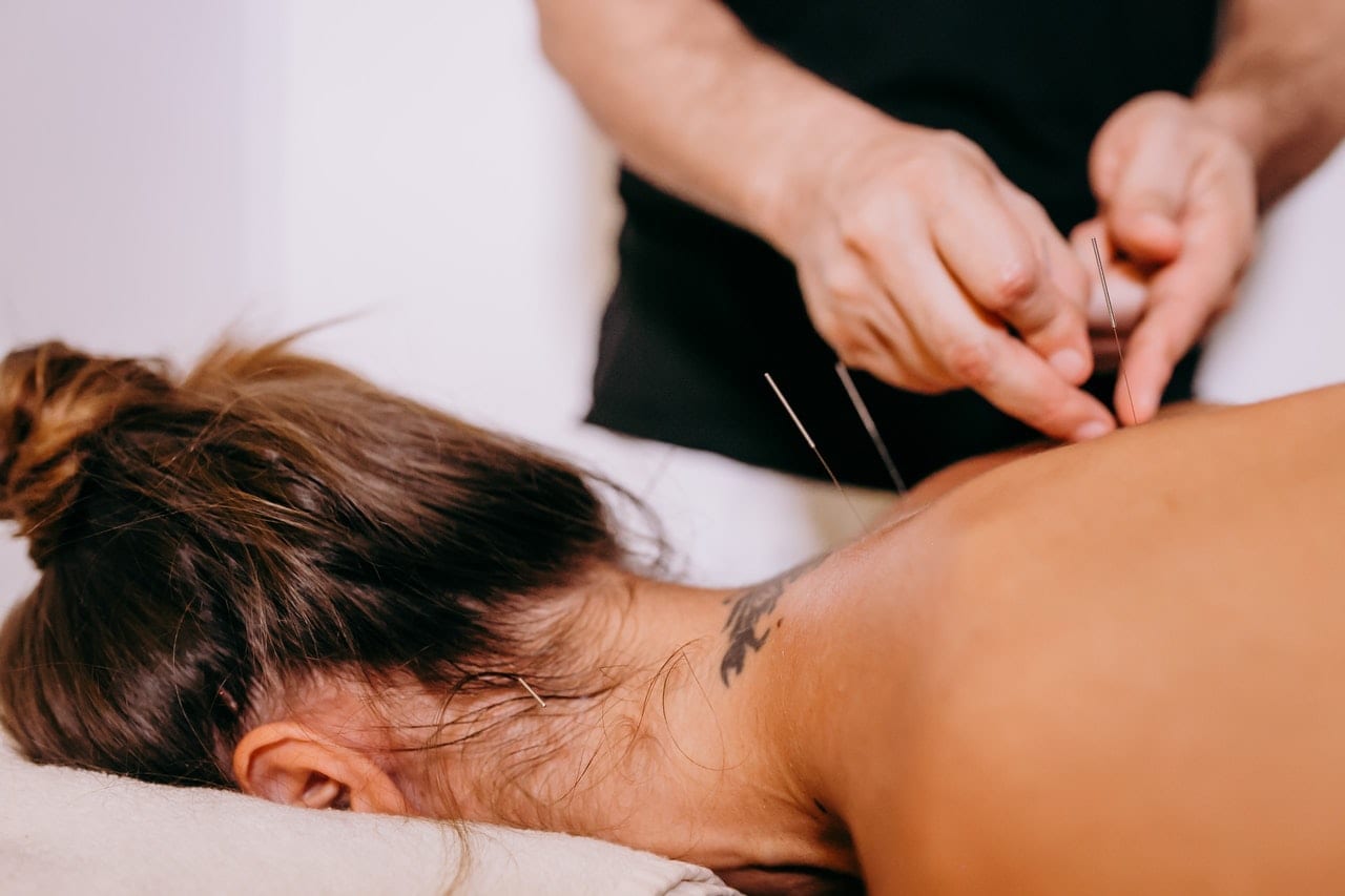 person performing an acupuncture on a lady